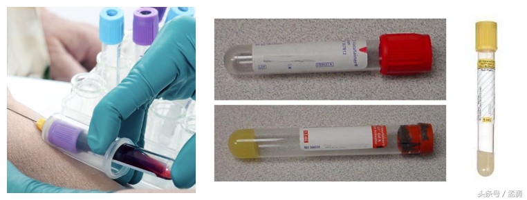 ca199升高怎么治疗,ca19937.3偏高吗