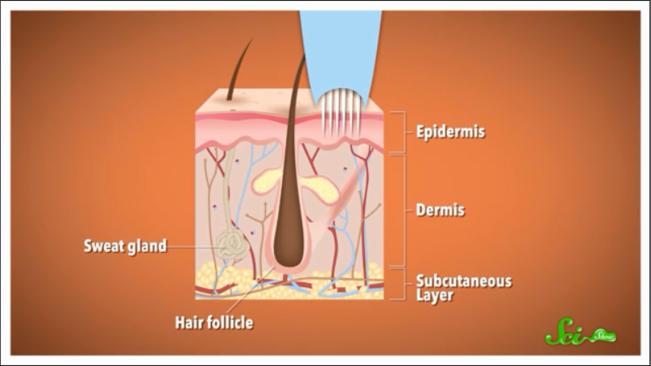 现在怎么去除纹身,怎么才可以去除纹身