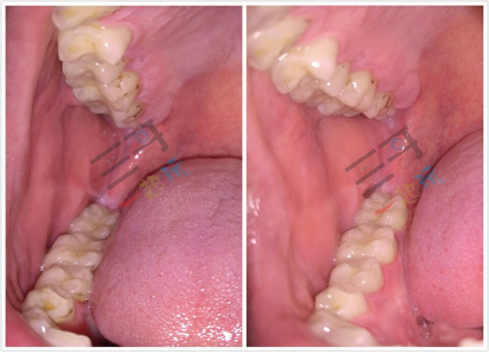 亲身体验清洁效果,洗牙体验全视频