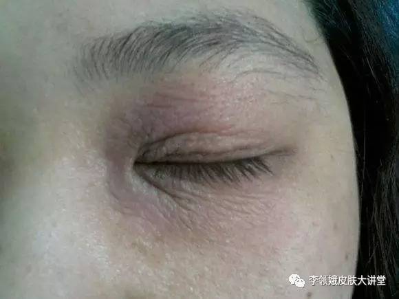 神经性皮炎牛皮癣湿疹会传染吗,头皮神经性皮炎和牛皮癣的区别