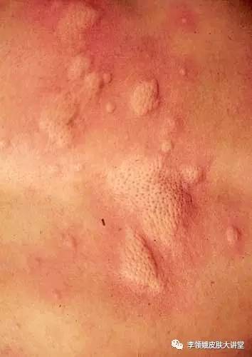 麻疹荨麻疹反复是什么原因,麻疹持续瘙痒几天