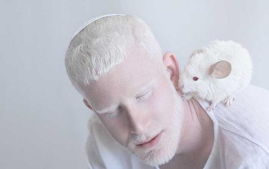 白化病治愈成功,白化病做什么基因检测