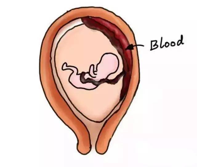 胎盘早剥,骤然来临的嗜血恶魔