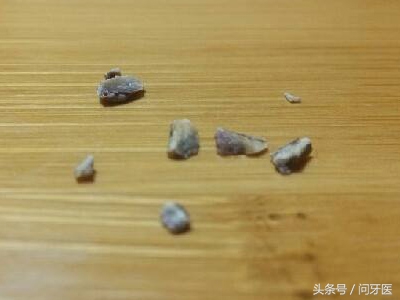 从牙缝中抠出一大块牙结石,从牙齿里面抠掉碎块很臭怎么消除