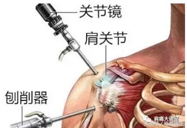 肩周炎积水潭专家,肩周炎医生讲解