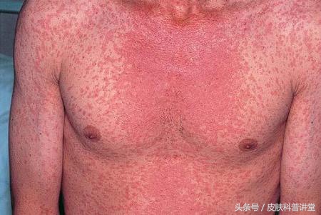 如何辨别儿童猩红热,儿童猩红热的症状与表现