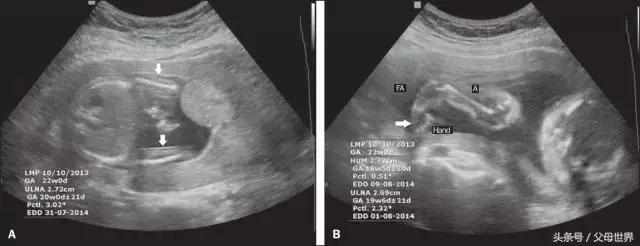 孕期如何快速看懂b超单,整个孕期b超究竟都能查出些什么