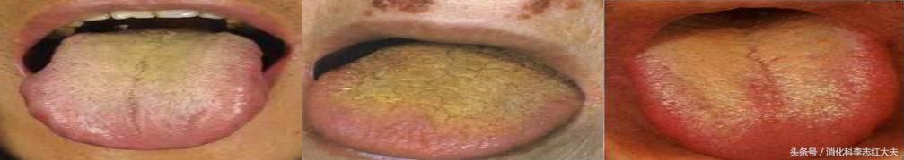 反流食管炎加萎缩性胃炎中医治疗,反流性食管炎中医把脉能看出来吗