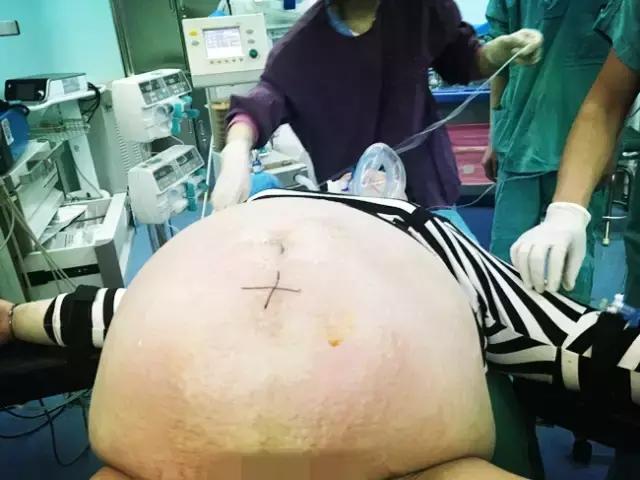 小伙子肚子突然变大原来是怀孕了,孕妇临产肚子越来越大