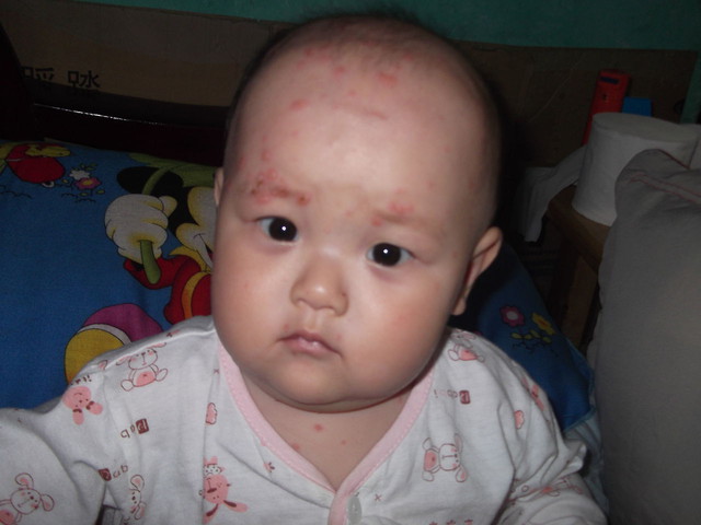 六个月宝宝感染水痘,六个月宝宝出水痘发烧了怎么办