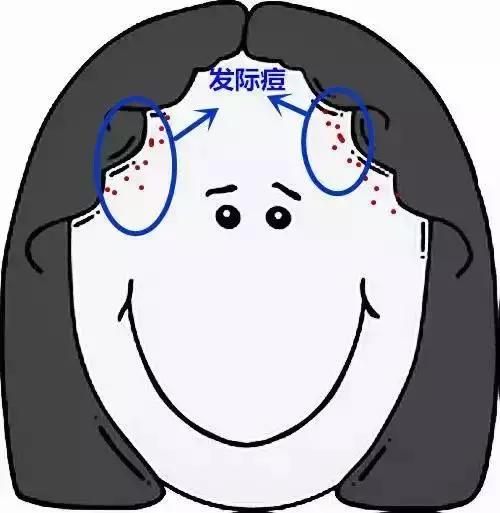 脸上长个痘痘挤出来白色的臭臭的,胳膊上有痘痘挤出来是白色条状物