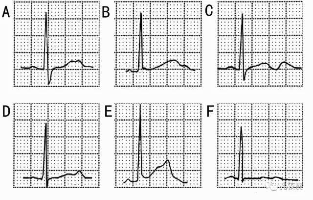 qt和qtc间期正常值范围,qtc间期