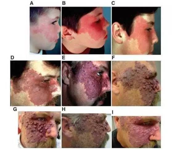 还在担心宝宝脸上的红印子会影响颜值？快来看华西专家咋个说！（内有福利）