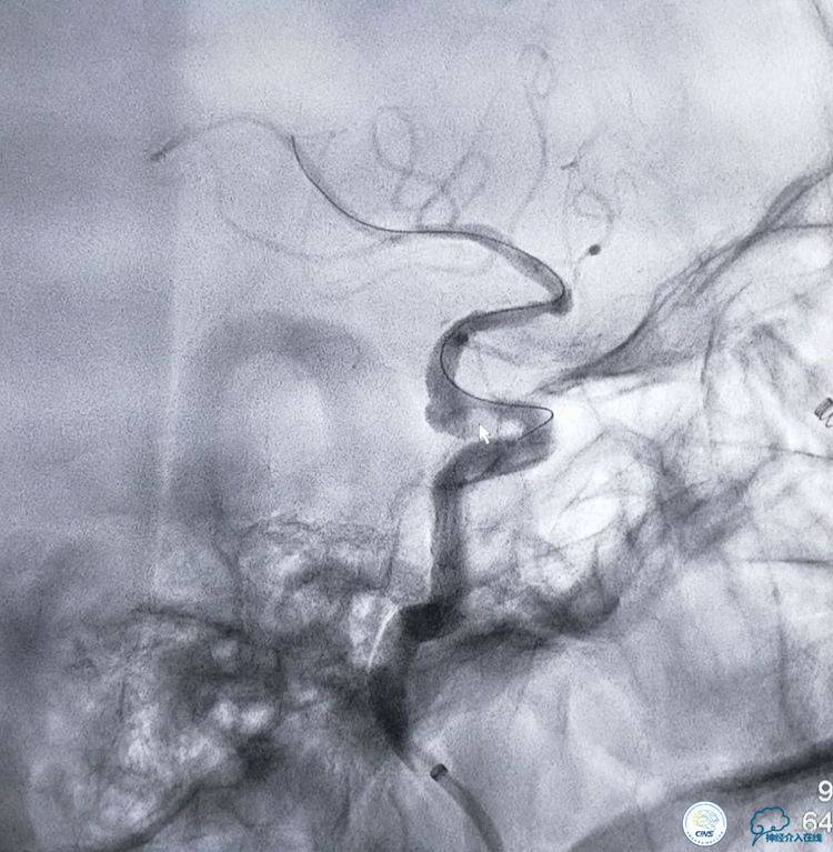 支架辅助弹簧圈栓塞治疗狭窄伴复杂动脉瘤