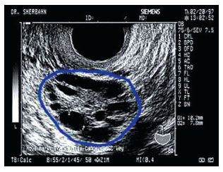 多囊卵巢综合征怎么选择治疗方法,多囊卵巢综合征的症状和解决办法