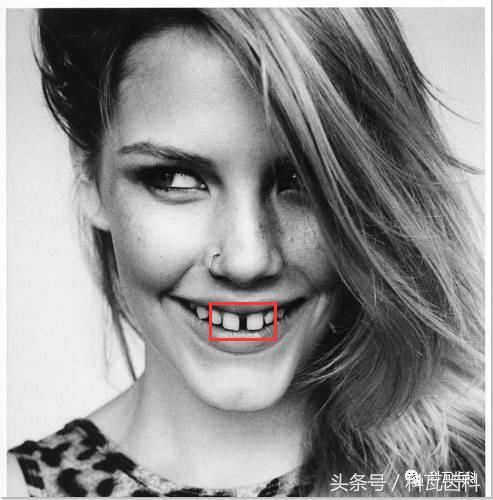 门下门牙有缝隙怎么补救,门牙开缝怎么处理最好