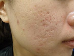 脸上各部位长痘原因和改善方法,满脸长痘的原因及调理方法