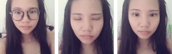 做双眼皮是如何打麻药的,其实做双眼皮没想象中那么疼