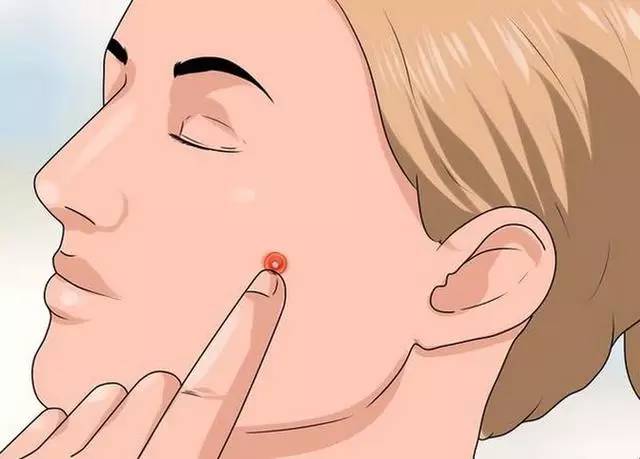 痘痘可以自己用针挤吗,痘可以挤吗