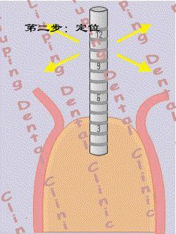 种植牙到底有多痛苦,种植牙真实经历详细全部过程