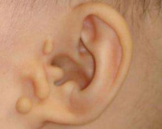 小孩耳边长个肉疙瘩是什么,宝宝耳边长了点凸起的肉