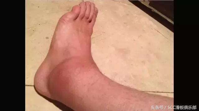 怎么快速恢复崴伤的脚踝,如何彻底治愈脚踝陈旧性扭伤