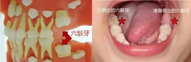 小孩开始换牙了,宝爸宝妈看过来你家宝贝换牙了吗