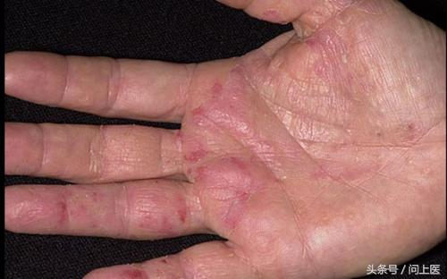 图解成年人常见的皮肤问题