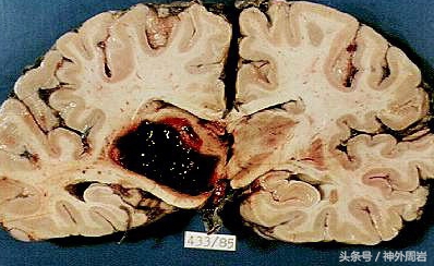 脑出血和脑溢血有何区别,脑出血与脑溢血是什么原因引起的