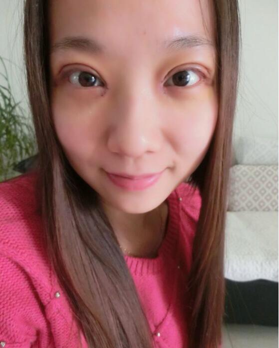 完美的埋线双眼皮,完美双眼皮