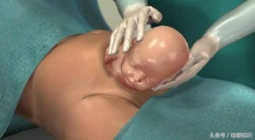 剖腹产疤痕误区,剖腹产常见的最基本的问题