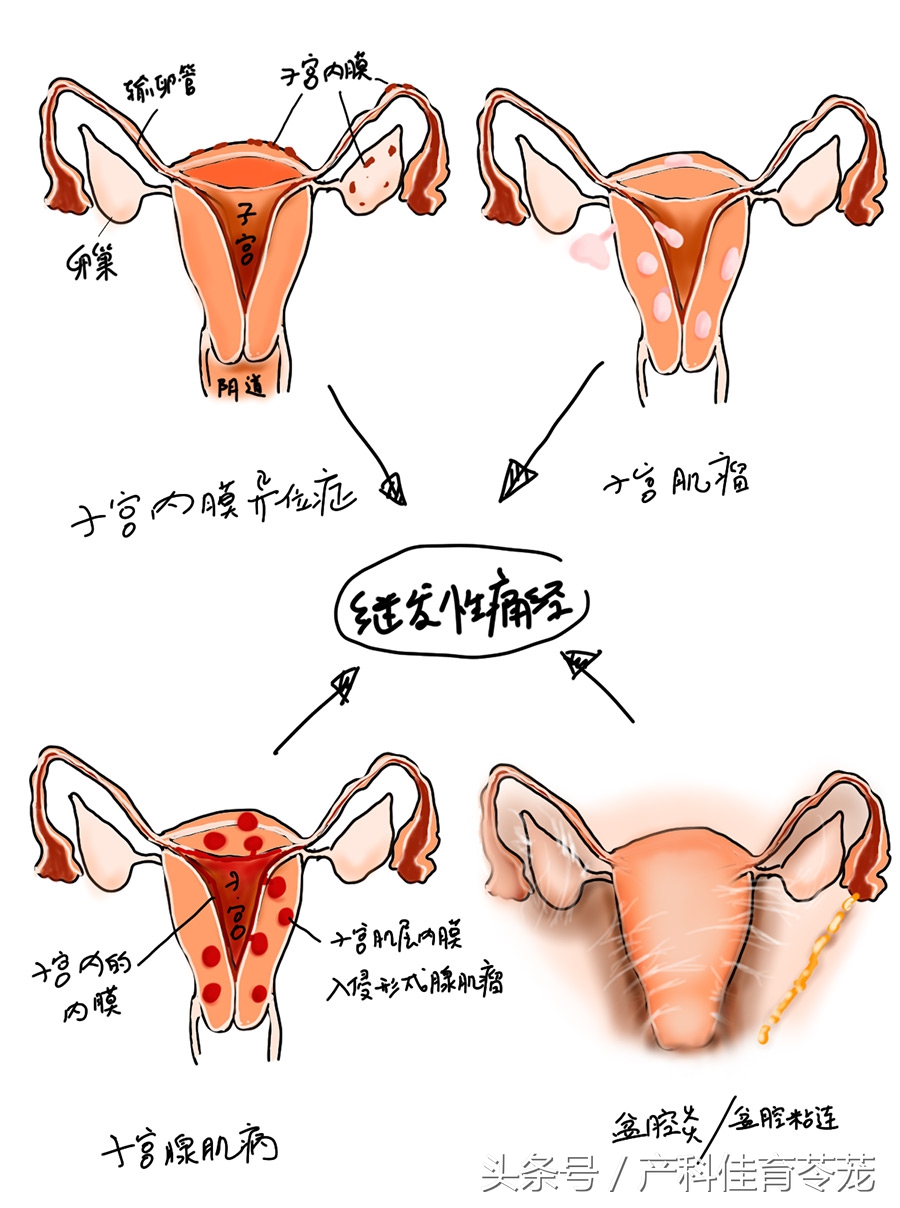 痛经有可能是癌症吗,痛经可能是妇科炎症吗