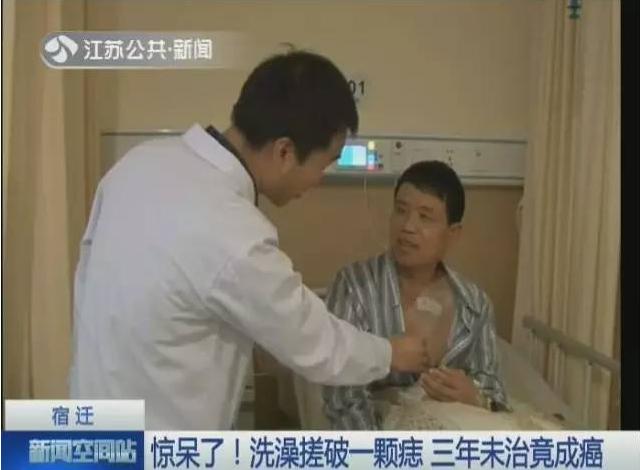 搓澡会让痣癌变吗,洗澡搓破痣竟成癌