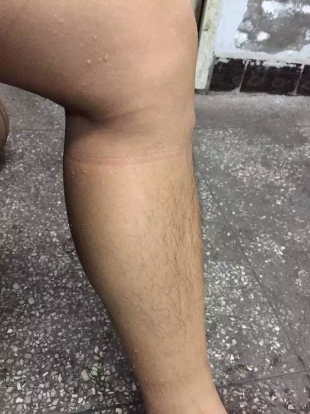 答疑（18）：瘦小腿不太容易（伤病类答疑）