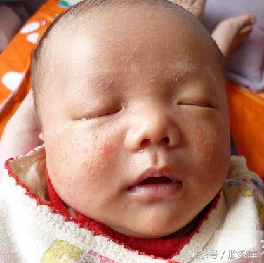 婴儿湿疹要用什么方法去预防,婴儿湿疹怎么避免和预防