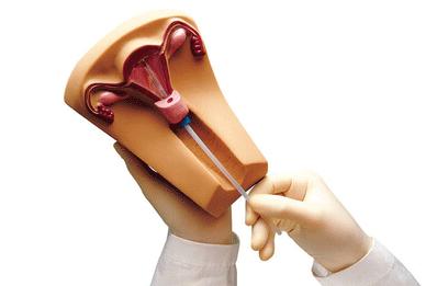 节育环要什么时候取才是最佳时期,节育环取出注意事项