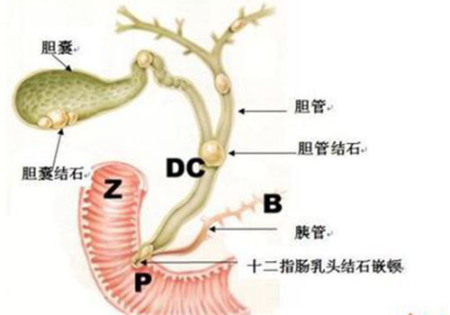 肝胆排石只喝三天的苹果汁行吗,苹果汁为什么可以排肝胆结石
