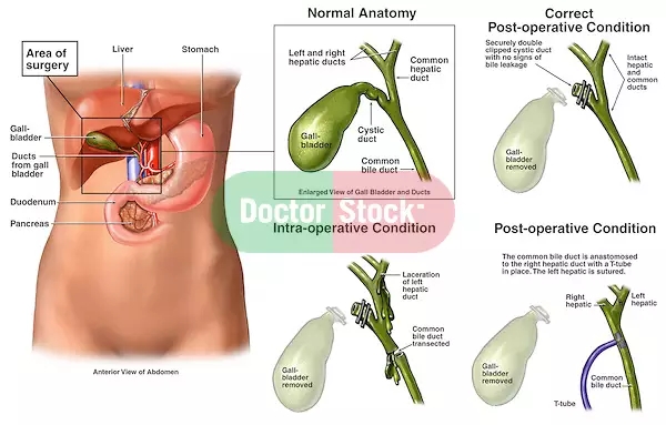 军队体检胆囊息肉标准,征兵体检胆囊息肉的标准