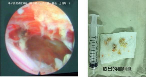 椎间孔镜微创腰椎退行性改变,腰椎椎间孔镜微创手术怎么做
