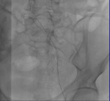 下肢肿胀有效的治疗手段是什么？