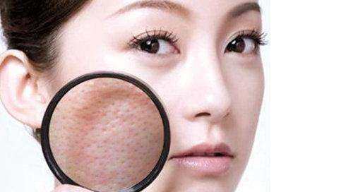 收缩毛孔最好的产品,什么药可以收缩毛孔