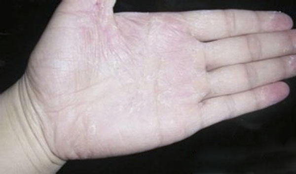 手掌脱皮中医,手掌脱皮中医怎么说