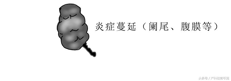 治疗盆腔炎要趁早！不然有大事发生