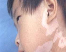 uvb治疗白癜风,uvb治疗白癜风时能照射好的皮肤吗