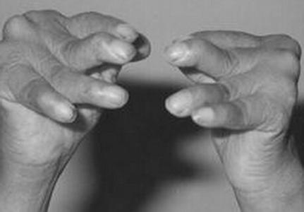 咽部异物感噎得慌,咽部吞咽异物感一般会是什么病症