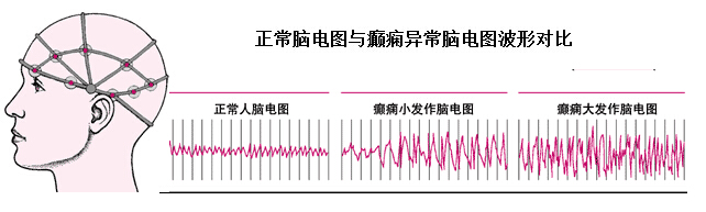 脑缺氧脑电图异常多久恢复,脑电图beam异常啥意思