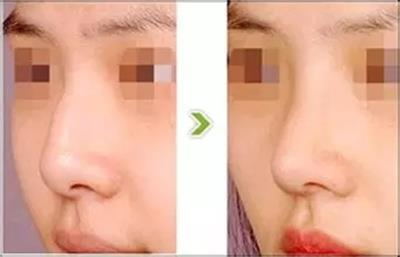鼻部整形有哪些注意事项,鼻部整形一个月内能做剧烈运动吗