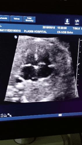 孕三月检查nt有点厚怎么办,产检nt高是什么原因导致的