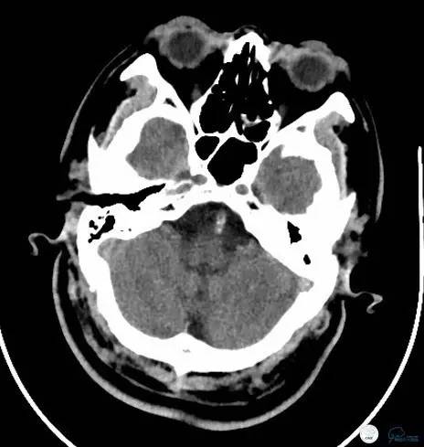 椎动脉狭窄支架植入术需要多少钱,颅内动脉狭窄支架手术后哪些症状