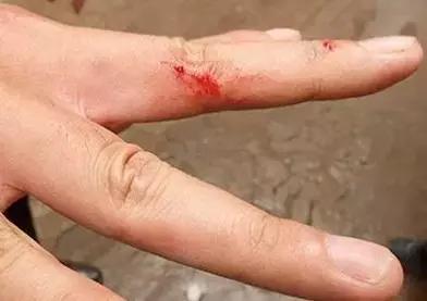 我滴个天呐！男子被木屑刺伤一个月后突发重病险丧命！